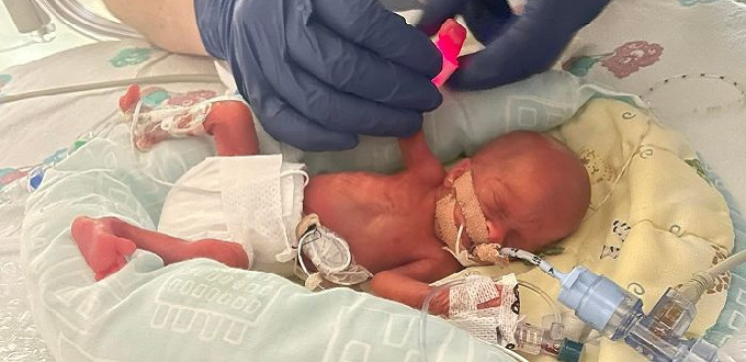 El «milagro» de la pequea Hanna: naci con solo 25 semanas de gestacin y 325 gramos