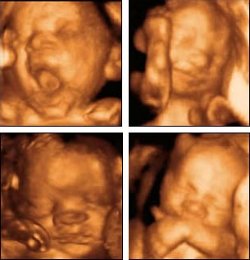Directora de clínica abortista se vuelve pro-vida tras ver ecografías de un aborto