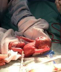 La foto de una bebé nacida tras 24 semanas de gestación demuestra la realidad del aborto