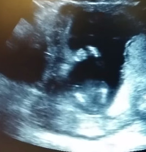 Un feto de 14 semanas aplaude de contento durante una ecografía