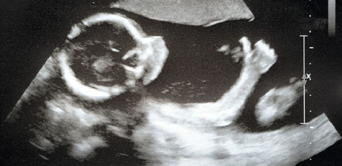 Lubbock, Texas, se vuelve libre del aborto después de que Planned Parenthood retira la demanda contra la prohibición del aborto